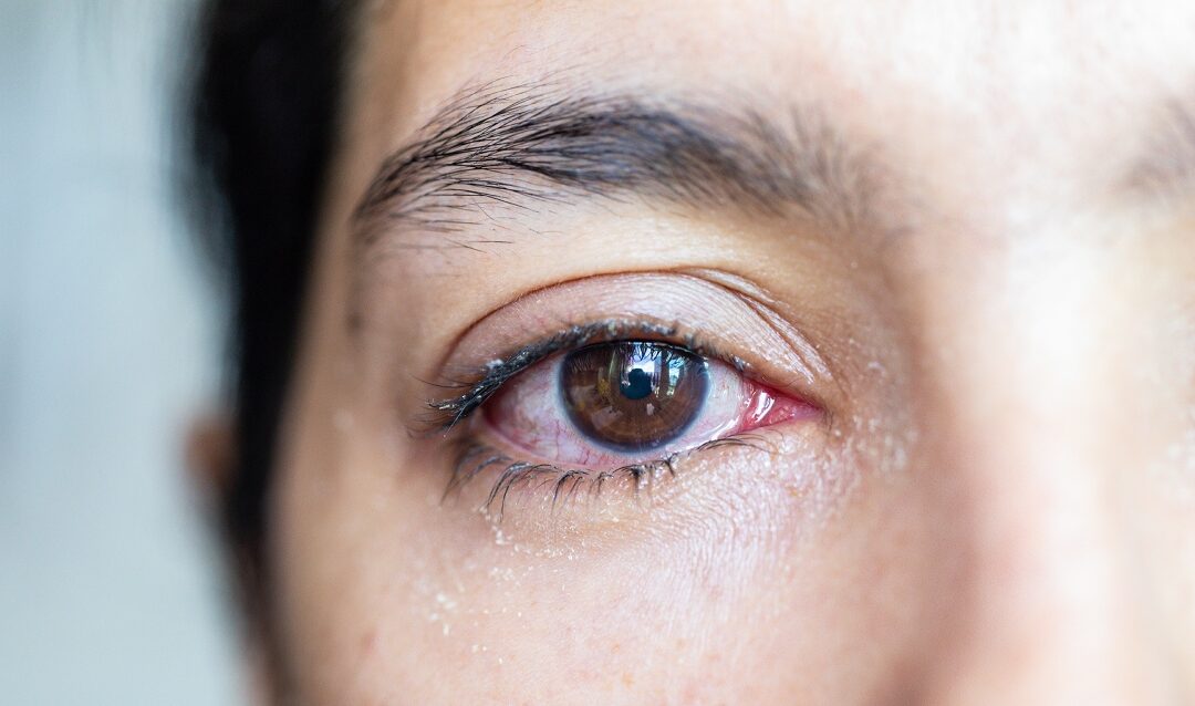 Watery Eyes? It May Not Be What You Think