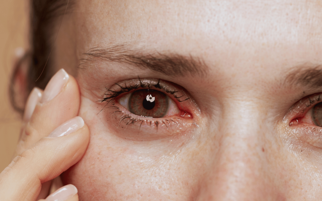 Why Are My Eyes Red After Wearing Contact Lenses?